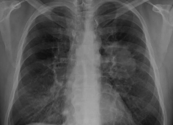 O que pode ter causado a pneumonia do Papa Francisco – AJN1
