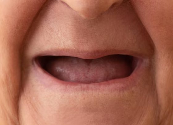 como cuidar da saúde bucal em casos de boca seca – AJN1