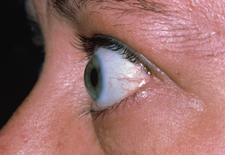 Autoimune, Doença Ocular da Tireoide pode fazer com que olhos saltem, provocando alteração estética e até cegueira