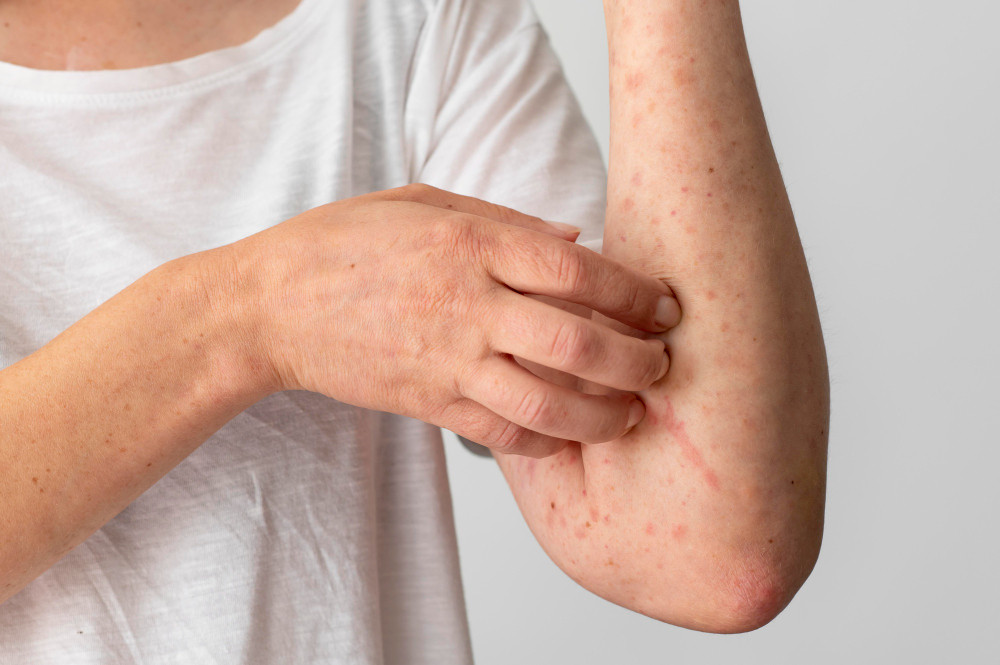 Dermatite Atópica afeta pele, mas impactos podem chegar ao sono e à vida social