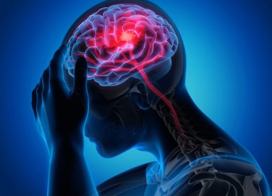Dia Mundial do AVC:  Neurologista orienta sobre os sinais da doença e as formas de prevenção